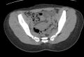 Bilateral mature cystic ovarian teratoma (Radiopaedia 88821-105592 Axial non-contrast 11).jpg