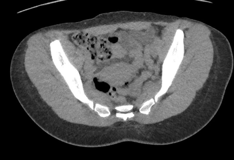 File:Bilateral mature cystic ovarian teratoma (Radiopaedia 88821-105592 Axial non-contrast 11).jpg