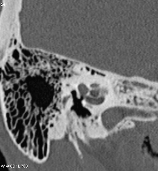 File:Bilateral otosclerosis with left stapes prosthesis (Radiopaedia 5567-7302 Coronal bone window 11).jpg