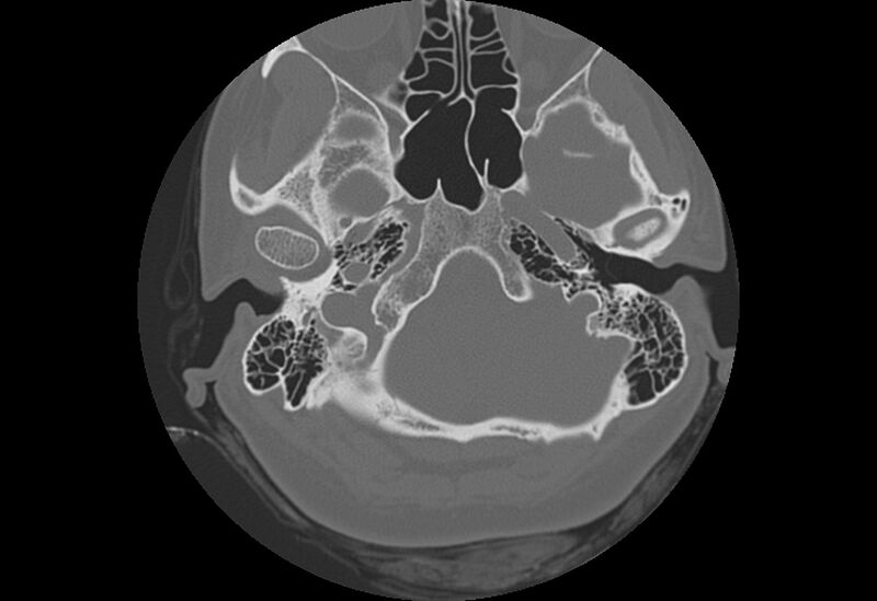 File:Bilateral otospongiosis (Radiopaedia 35447-36940 B 15).jpg