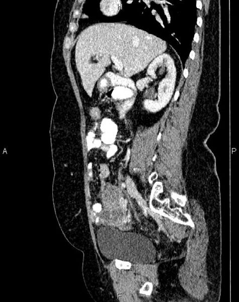File:Bilateral ovarian serous cystadenocarcinoma (Radiopaedia 86062-101989 E 29).jpg