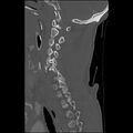 Bilateral perched facets with cord injury (Radiopaedia 45587-49713 Sagittal bone window 19).jpg