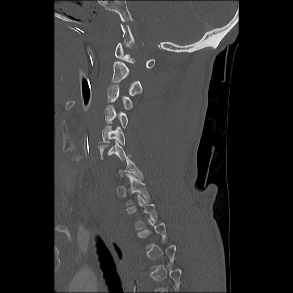 File:Bilateral perched facets with cord injury (Radiopaedia 45587-49713 Sagittal bone window 19).jpg
