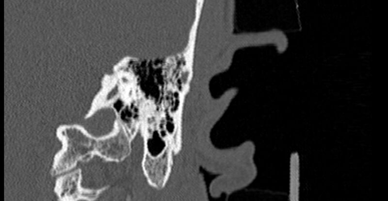File:Bilateral temporal bone fractures (Radiopaedia 29482-29970 B 66).jpg