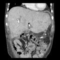 Biliary necrosis - liver transplant (Radiopaedia 21876-21846 C 11).jpg