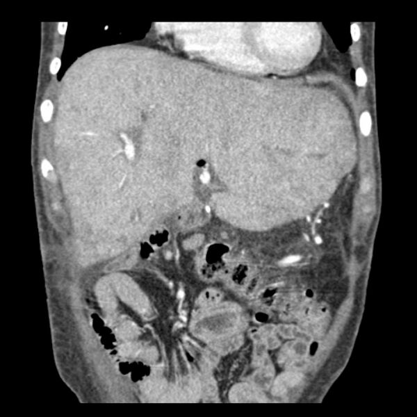 File:Biliary necrosis - liver transplant (Radiopaedia 21876-21846 C 11).jpg