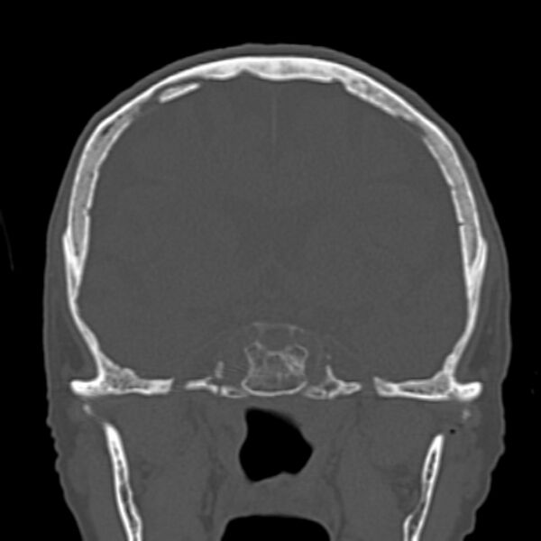 File:Biparietal osteodystrophy (Radiopaedia 46109-50463 Coronal bone window 50).jpg