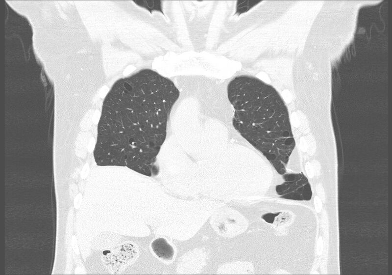 File:Birt-Hogg-Dubé syndrome (Radiopaedia 52578-58491 Coronal lung window 11).jpg
