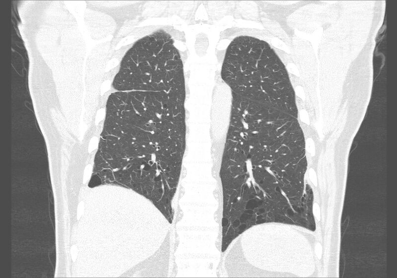 File:Birt-Hogg-Dubé syndrome (Radiopaedia 52578-58491 Coronal lung window 46).jpg