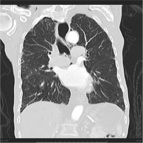 File:Boerhaave syndrome (Radiopaedia 26240-26362 Coronal lung window 17).jpg