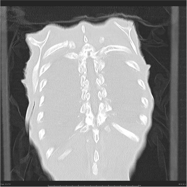 File:Boerhaave syndrome (Radiopaedia 26240-26362 Coronal lung window 32).jpg