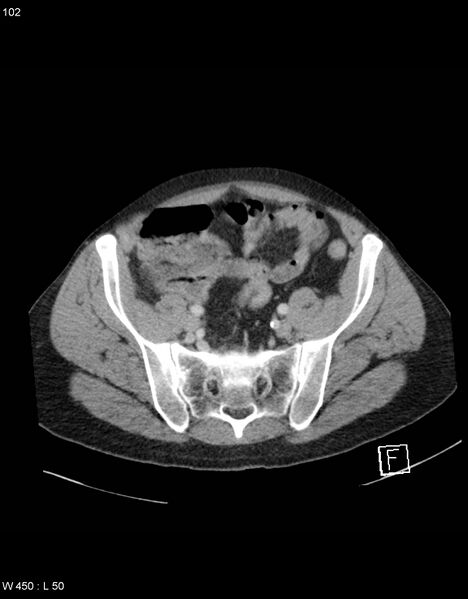 File:Boerhaave syndrome with tension pneumothorax (Radiopaedia 56794-63603 A 51).jpg