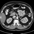 Bosniak cyst - type IV (Radiopaedia 23525-23627 renal cortical phase 15).jpg