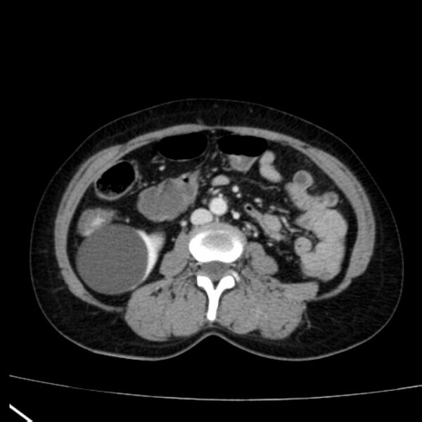 File:Bosniak renal cyst - type I (Radiopaedia 27479-27675 C 47).jpg