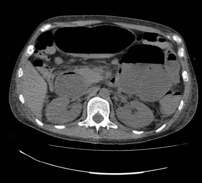 File:Bowel lymphoma complicated by bleeding after therapy (Radiopaedia 55601-62110 Axial non-contrast 30).jpg