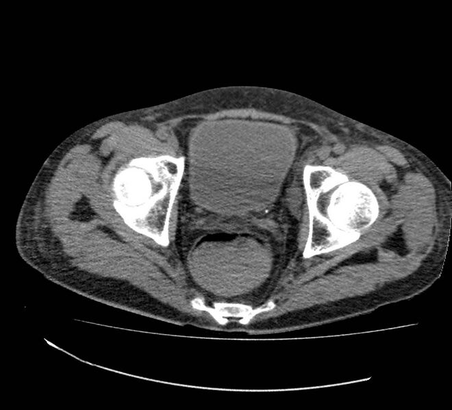 File:Bowel lymphoma complicated by bleeding after therapy (Radiopaedia 55601-62110 Axial non-contrast 75).jpg