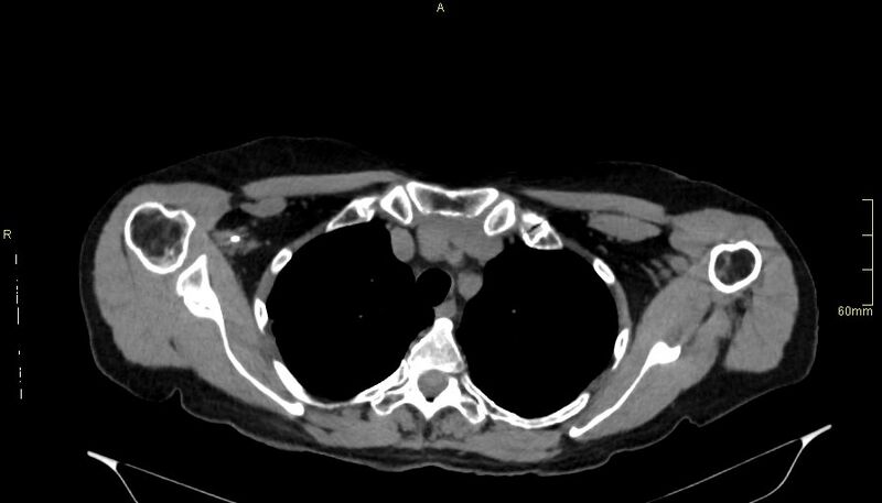 File:Brachial artery foreign body (Radiopaedia 54583-60820 Axial non-contrast 19).jpg
