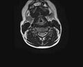 Brachial plexus birth palsy (Radiopaedia 68118-77604 Axial T2 9).jpg