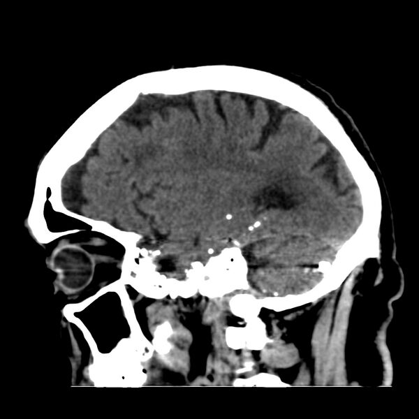 File:Brain Pantopaque remnants (Radiopaedia 78403-91048 C 40).jpg
