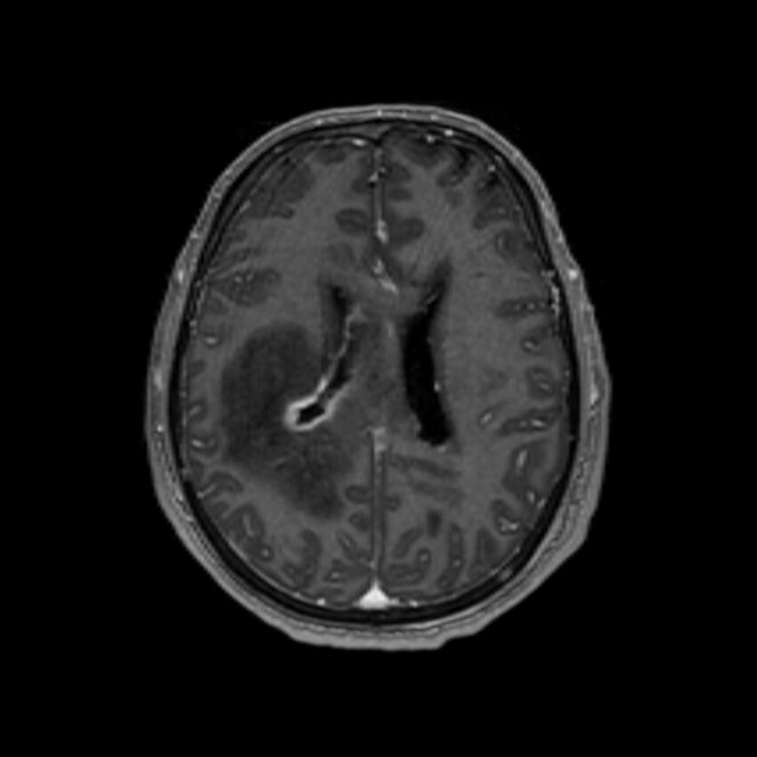 Brain abscess complicated by intraventricular rupture and ventriculitis (Radiopaedia 82434-96577 Axial T1 C+ 44).jpg