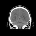 Brain death (Radiopaedia 78597-91360 Coronal non-contrast 54).jpg