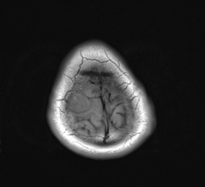 File:Brain metastases - lung cancer primary (Radiopaedia 75060-86115 Axial T1 23).jpg