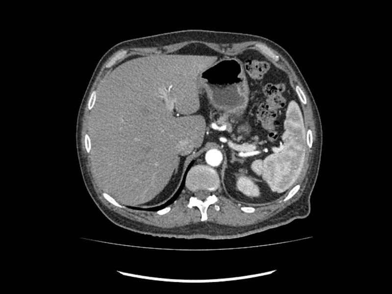 File:Brain metastases from renal cell carcinoma (Radiopaedia 42222-45328 A 3).jpg