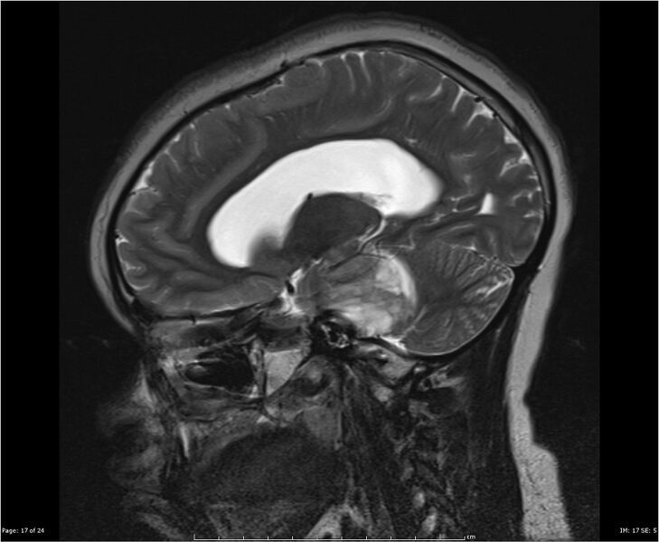 File:Brainstem glioma (Radiopaedia 21819-21775 Sagittal T2 17).jpg