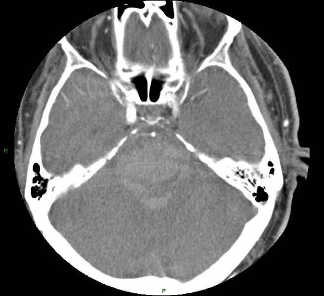 File:Brainstem hemorrhage (Radiopaedia 58794-66028 D 64).jpg