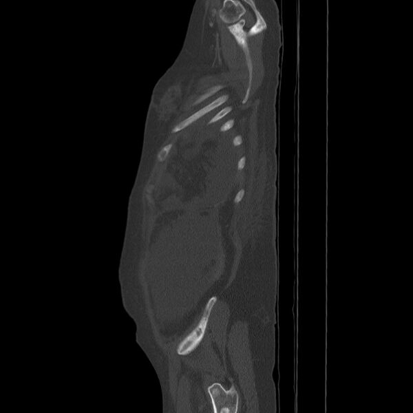 File:Breast cancer metastases - hepatic and skeletal (Radiopaedia 34201-35461 Sagittal bone window 83).jpg