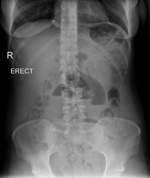 File:Broad ligament hernia (Radiopaedia 63260-71830 B 1).jpg