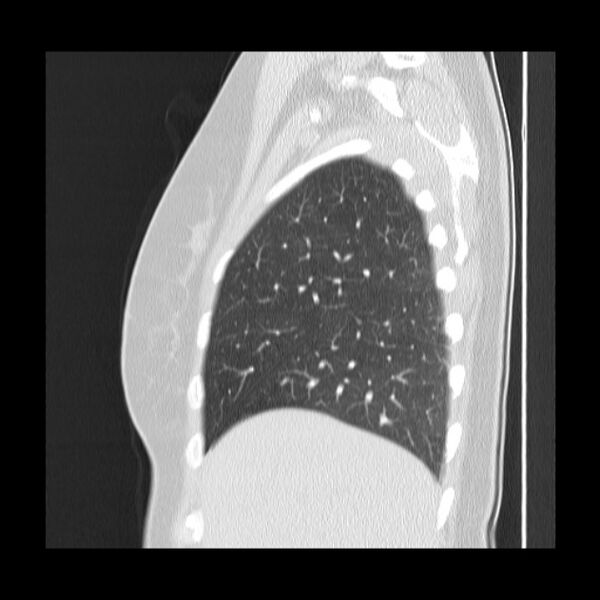 File:Bronchial atresia (Radiopaedia 22965-22992 Sagittal lung window 45).jpg