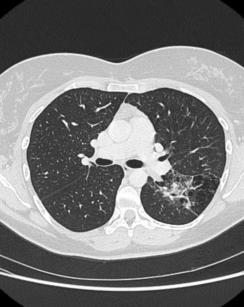 Bronchial atresia (Radiopaedia 50007-55297 Axial lung window 44).jpg