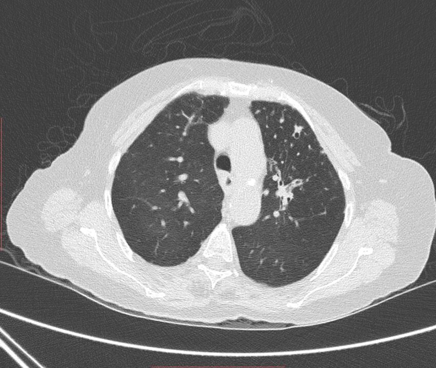 Bronchiectasis (Radiopaedia 72693-83293 Axial lung window 36).jpg