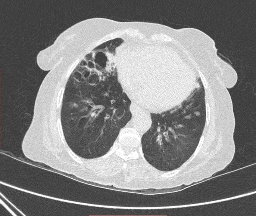 Bronchiectasis (Radiopaedia 72693-83293 Axial lung window 94).jpg