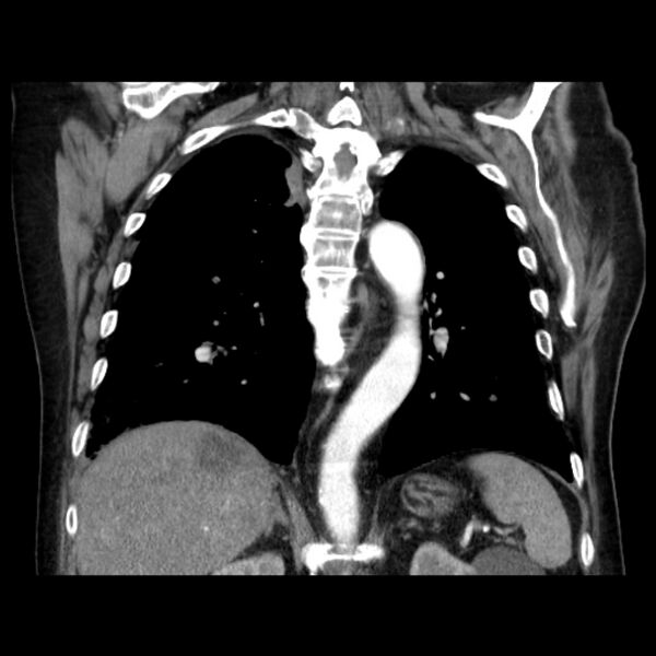 File:Bronchogenic adenocarcinoma and pulmonary embolism (Radiopaedia 9097-9806 C 34).jpg