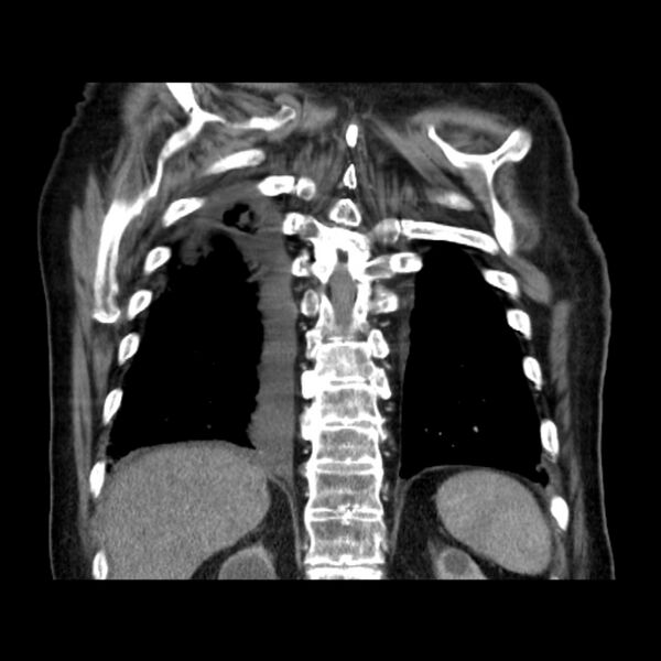 File:Bronchogenic adenocarcinoma and pulmonary embolism (Radiopaedia 9097-9806 C 41).jpg