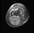 Bucket handle tear - medial meniscus (Radiopaedia 24900-25163 Axial T2 fat sat 1).png