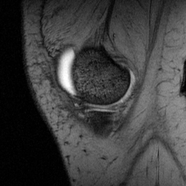 File:Bucket handle tear - medial meniscus (Radiopaedia 79028-91942 D 22).jpg