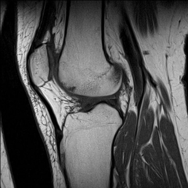 File:Bucket handle tear - medial meniscus (Radiopaedia 79028-91942 Sagittal T1 10).jpg
