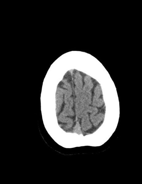 File:Burnt-out meningioma (Radiopaedia 51557-57337 Axial non-contrast 41).jpg