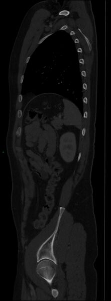 File:Burst fracture (Radiopaedia 83168-97542 Sagittal bone window 96).jpg