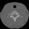 C5 facet fracture (Radiopaedia 58374-65499 Axial bone window 72).jpg