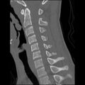 C5 facet fracture (Radiopaedia 58374-65499 Sagittal bone window 38).jpg