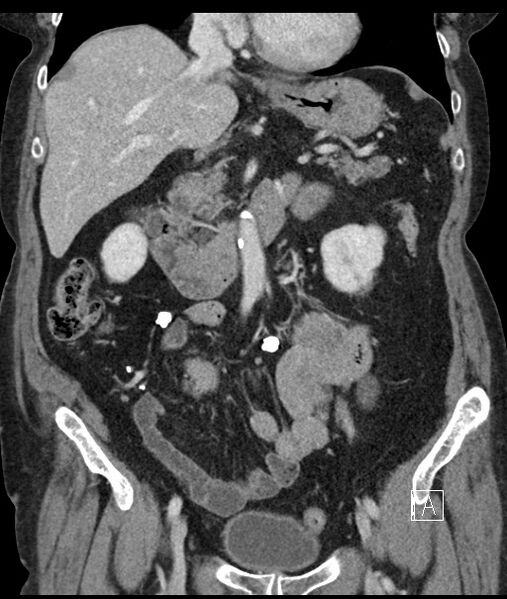 File:Calcified adrenal glands and Spigelian hernia (Radiopaedia 49741-54988 B 50).jpg