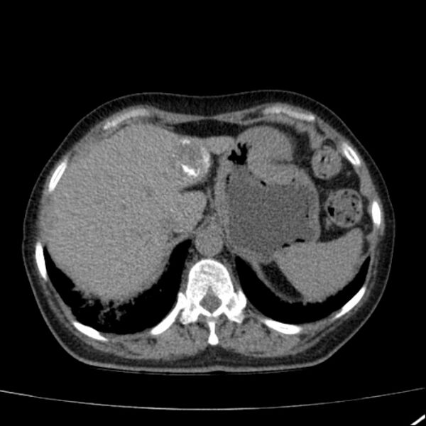File:Calcified hepatic hydatid cyst (Radiopaedia 26872-27046 Axial non-contrast 18).jpg