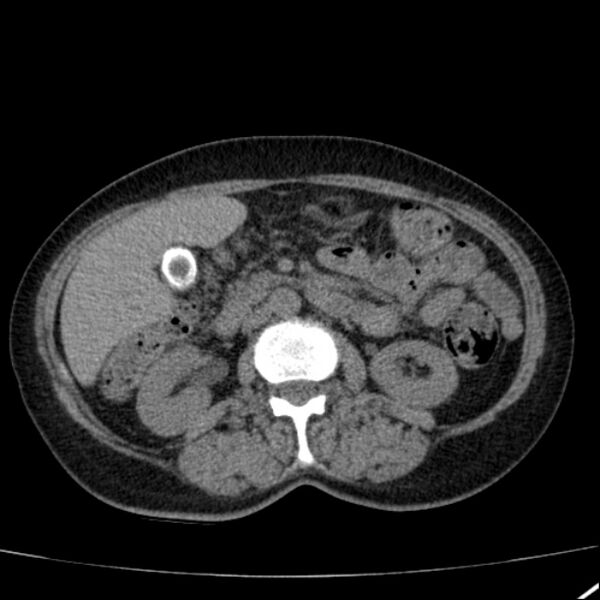 File:Calcified hepatic hydatid cyst (Radiopaedia 26872-27046 Axial non-contrast 39).jpg