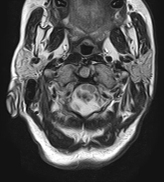 File:Calcified meningioma - cervical canal (Radiopaedia 70136-82468 Axial T2 4).jpg