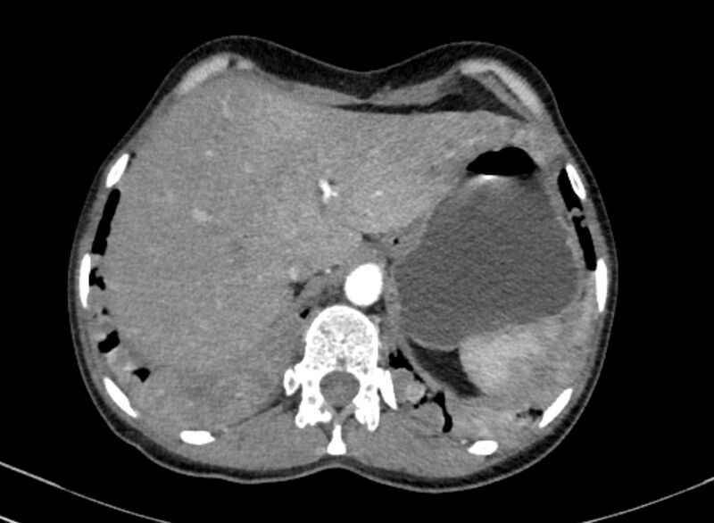File:Cannonball metastases from breast cancer (Radiopaedia 91024-108569 A 110).jpg