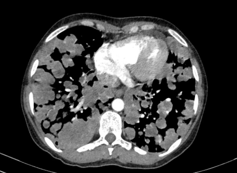 File:Cannonball metastases from breast cancer (Radiopaedia 91024-108569 A 89).jpg